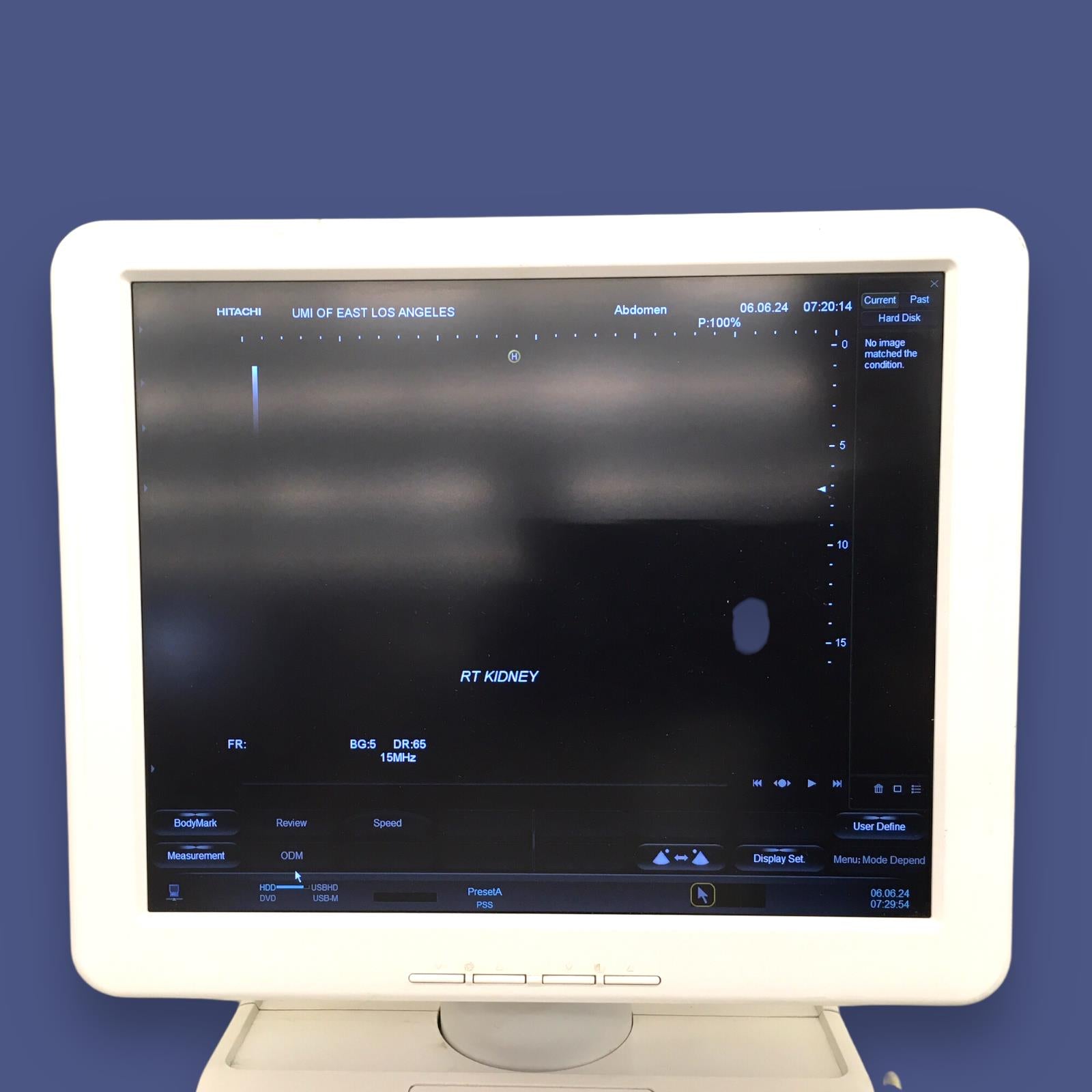 Hitachi Aloka High Vision Avius Breast Ultrasound