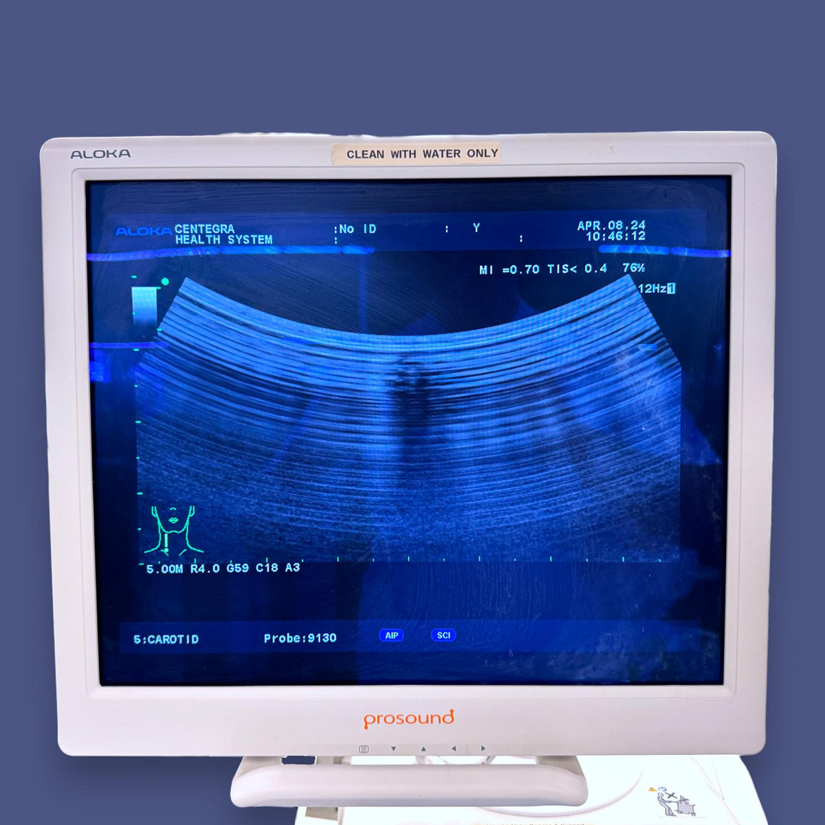 Hitachi Aloka SSD- a10 Prosound Ultrasound System w/ Aloka 9130 Probe